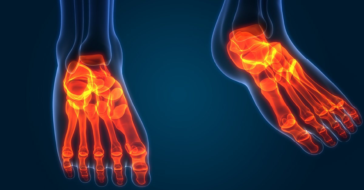 Overweight and obese people tend to have more foot pain than those who have a healthy weight. The link seems obvious -- more weight means more pressure on feet, right? The truth may not be so simple. wb.md/3I0glxL