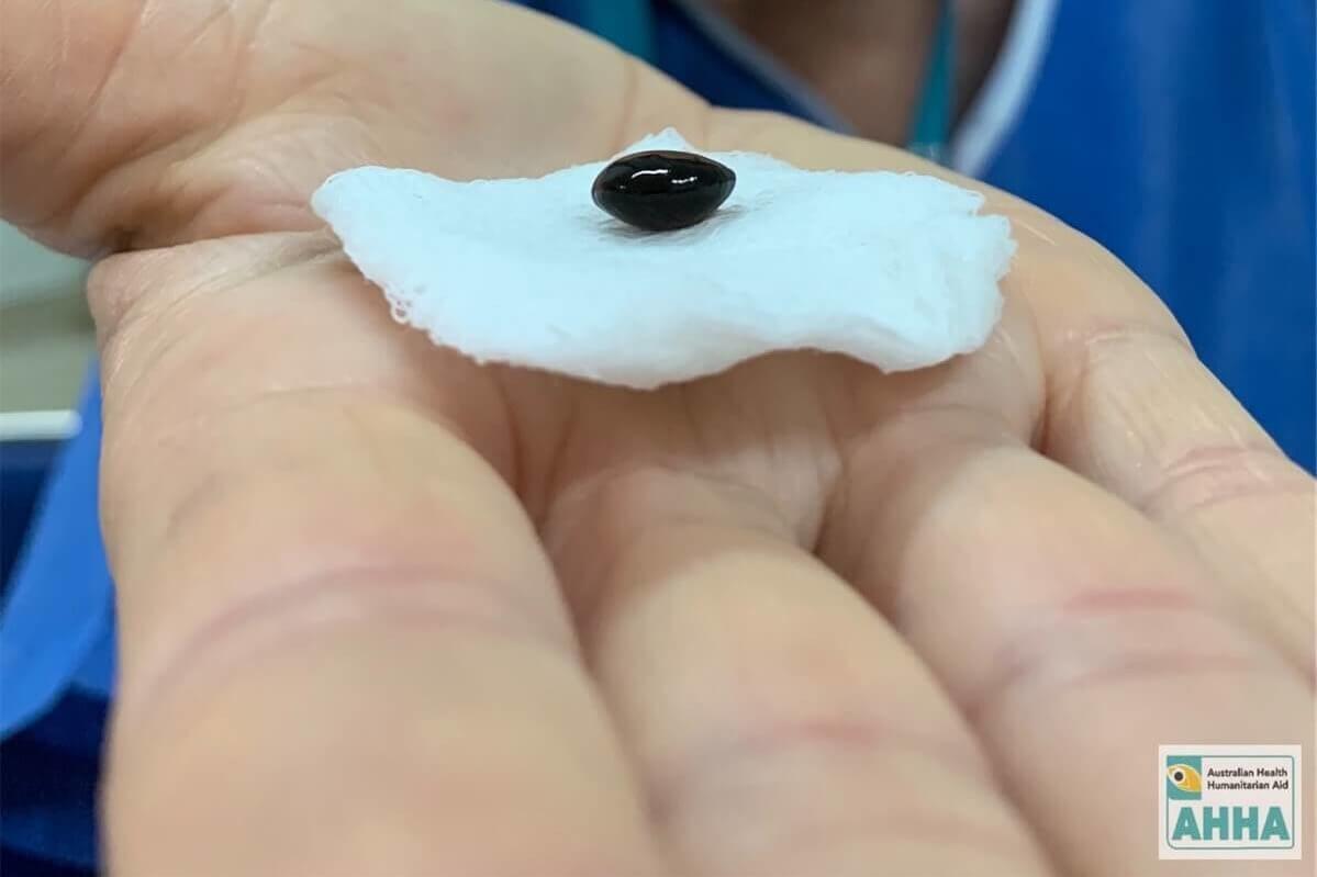 Eye_Institute's tweet image. For our final entries into the 7 Sights in 7 Days challenge, the 'Hmmm Sight' and the 'Culture Sight', we have: A black cataract removed on one of Dr Tess Huynh's trips to Cambodia, and the team at our Hurstville clinic having a multicultural lunch.

#TreatYourEyes