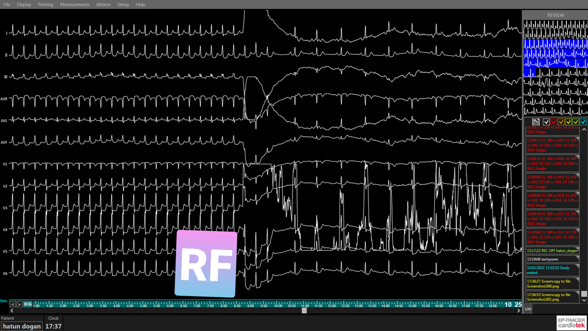Gökhan Aksan (@gkhanaksan) on Twitter photo 65 yo
Sustained parahisian AT
Ablation NCC
<a href="/Sabri_Demircan/">Sabri Demircan</a> <a href="/DursunAras2/">Dursun Aras, Professor</a> <a href="/ATARILYAS/">ILYAS ATAR</a> @drerkanbaysal <a href="/hikmetyorgun/">Hikmet Yorgun</a> <a href="/gokselcinier/">Göksel Çinier</a> <a href="/Hapa_EP/">Kevin Brady</a> <a href="/makkayadr/">Mehmet AKKAYA</a> <a href="/kayamehmet4635/">Mehmet Kaya</a> <a href="/furkanssenel/">Furkan Şenel</a> <a href="/drabdlkdruslu/">Abdulkadir Uslu</a> <a href="/MDTolgaAksu/">Tolga Aksu, MD</a> @BiosenseWebster <a href="/HappyEP/">Emin Evren Özcan</a> <a href="/TKDsosyal/">Turkish Society of Cardiology</a> 65 yo
Sustained parahisian AT
Ablation NCC
<a href="/Sabri_Demircan/">Sabri Demircan</a> <a href="/DursunAras2/">Dursun Aras, Professor</a> <a href="/ATARILYAS/">ILYAS ATAR</a> @drerkanbaysal <a href="/hikmetyorgun/">Hikmet Yorgun</a> <a href="/gokselcinier/">Göksel Çinier</a> <a href="/Hapa_EP/">Kevin Brady</a> <a href="/makkayadr/">Mehmet AKKAYA</a> <a href="/kayamehmet4635/">Mehmet Kaya</a> <a href="/furkanssenel/">Furkan Şenel</a> <a href="/drabdlkdruslu/">Abdulkadir Uslu</a> <a href="/MDTolgaAksu/">Tolga Aksu, MD</a> @BiosenseWebster <a href="/HappyEP/">Emin Evren Özcan</a> <a href="/TKDsosyal/">Turkish Society of Cardiology</a>