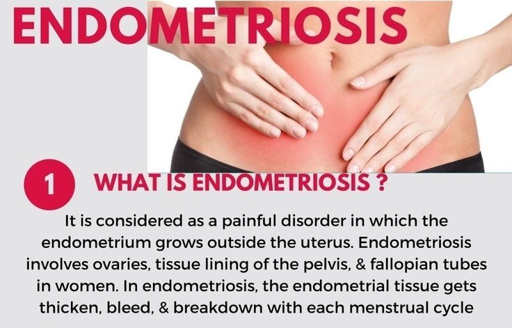 FoundationAdira's tweet photo. In this "ENDOMETRIOSIS AWARENESS MONTH" let's learn about what Endometriosis actually is...! 

#Endometriosis 
#EndometriosisAwarenessMonth
#EndometriosisAwareness 
#period
#taboo
#periodhealth https://t.co/8HXrGogXfG