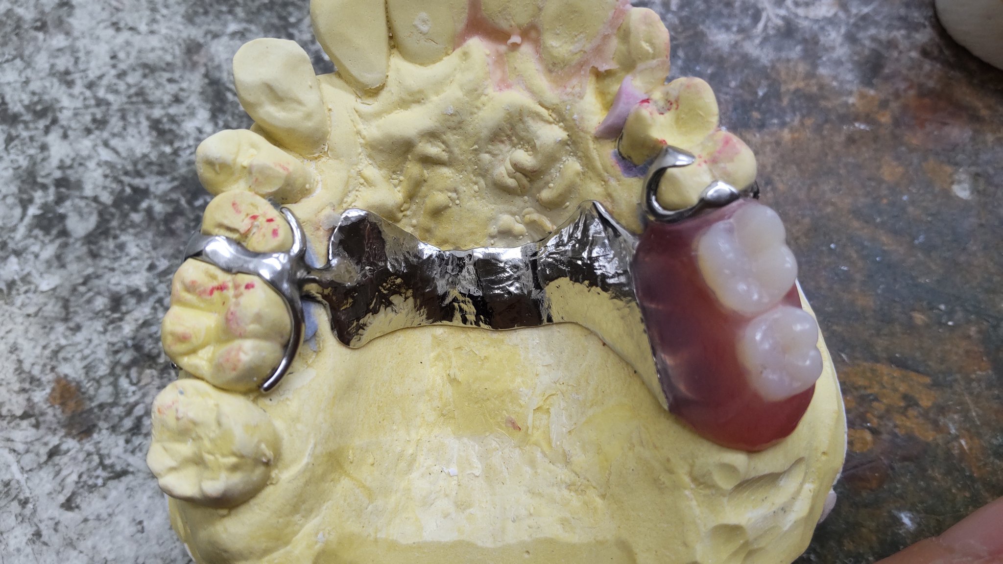 J☆Dental Laboratory on Twitter "〜保険の義歯でも違和感の少ない義歯を提供したい〜 保険の義歯に材料費や時間は