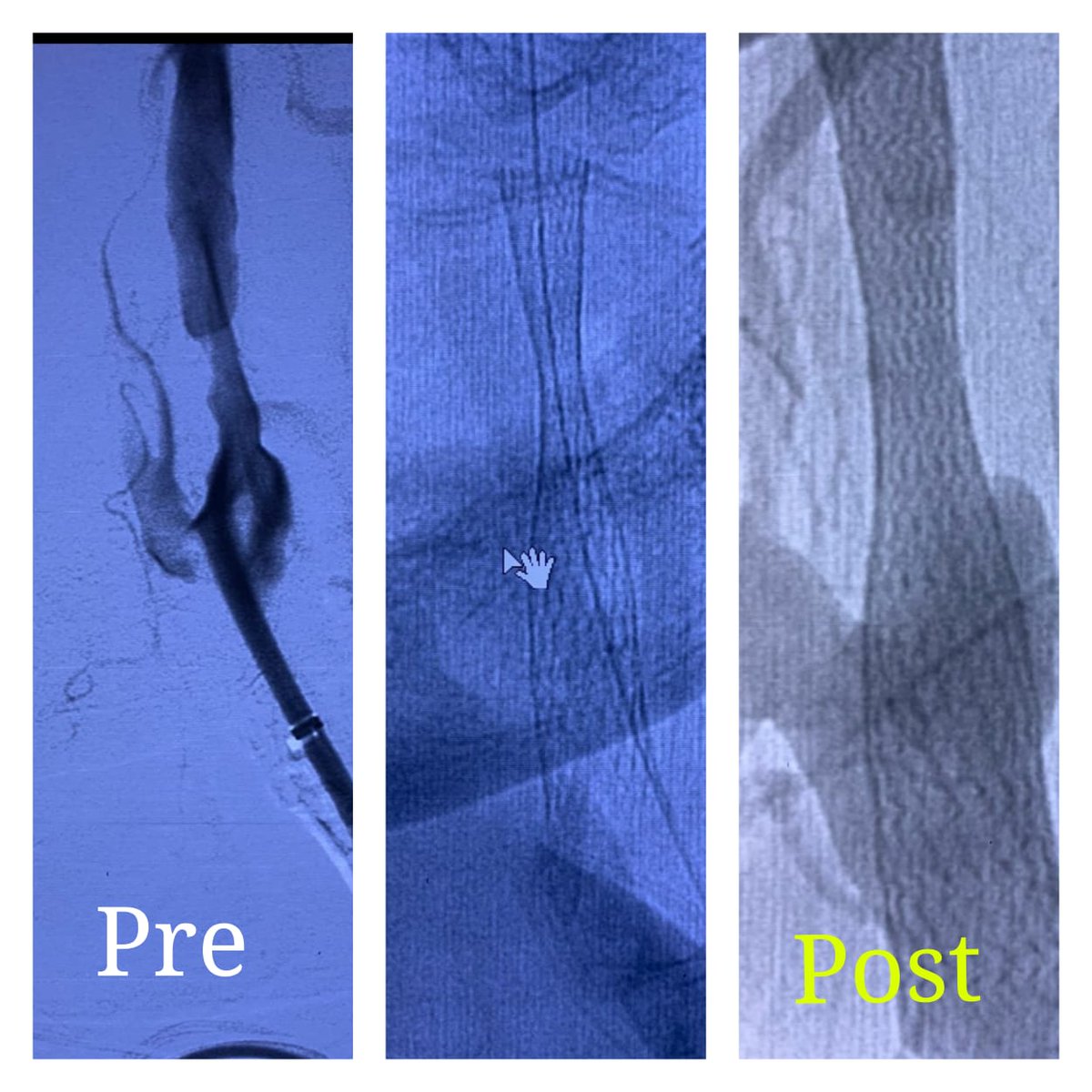 DrPNRenjen's tweet photo. A 80 year old lady with recurrent episodes of TIAs ( mini strokes) and strokes-- managed successfully with a carotid PTCA by Dr Nischint Jain, @DrPNRenjen and team at Indraprastha Apollo Hospital New Delhi.

#stroke #Neurology #neuroscience https://t.co/uB12fOHrz9