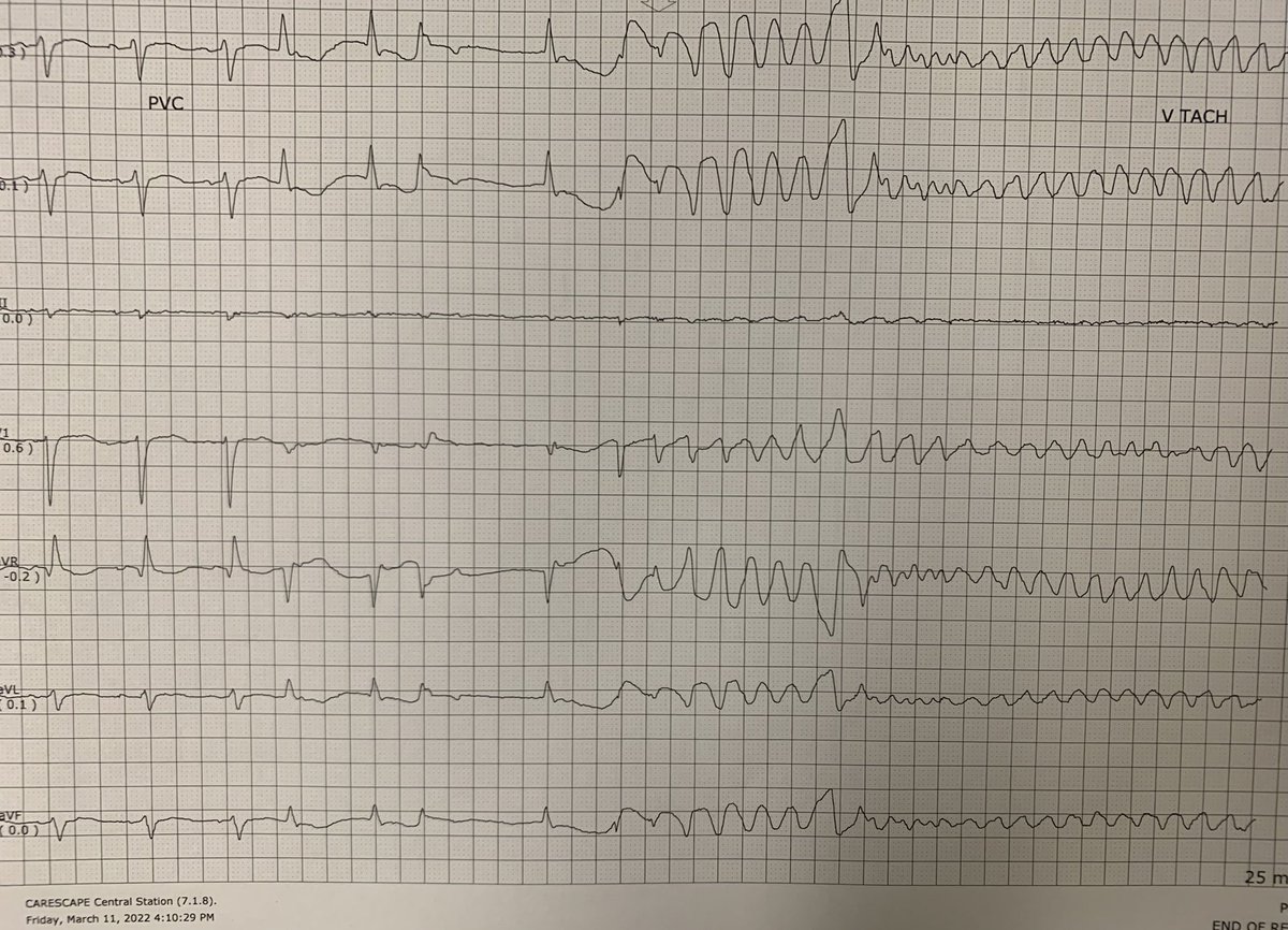 AllenAmornMD's tweet photo. What is the mechanism of this arrhythmia initiation? Poll below. #CardioTwitter #Fellowfirst #MedTwitter #FOAMed #MedEd @hajaw0 @LSUHS_CCDS @muutu15 @VishnuPriyaMD @AakashRSheth @JavariaahmadMD https://t.co/naZ4fwcJKe