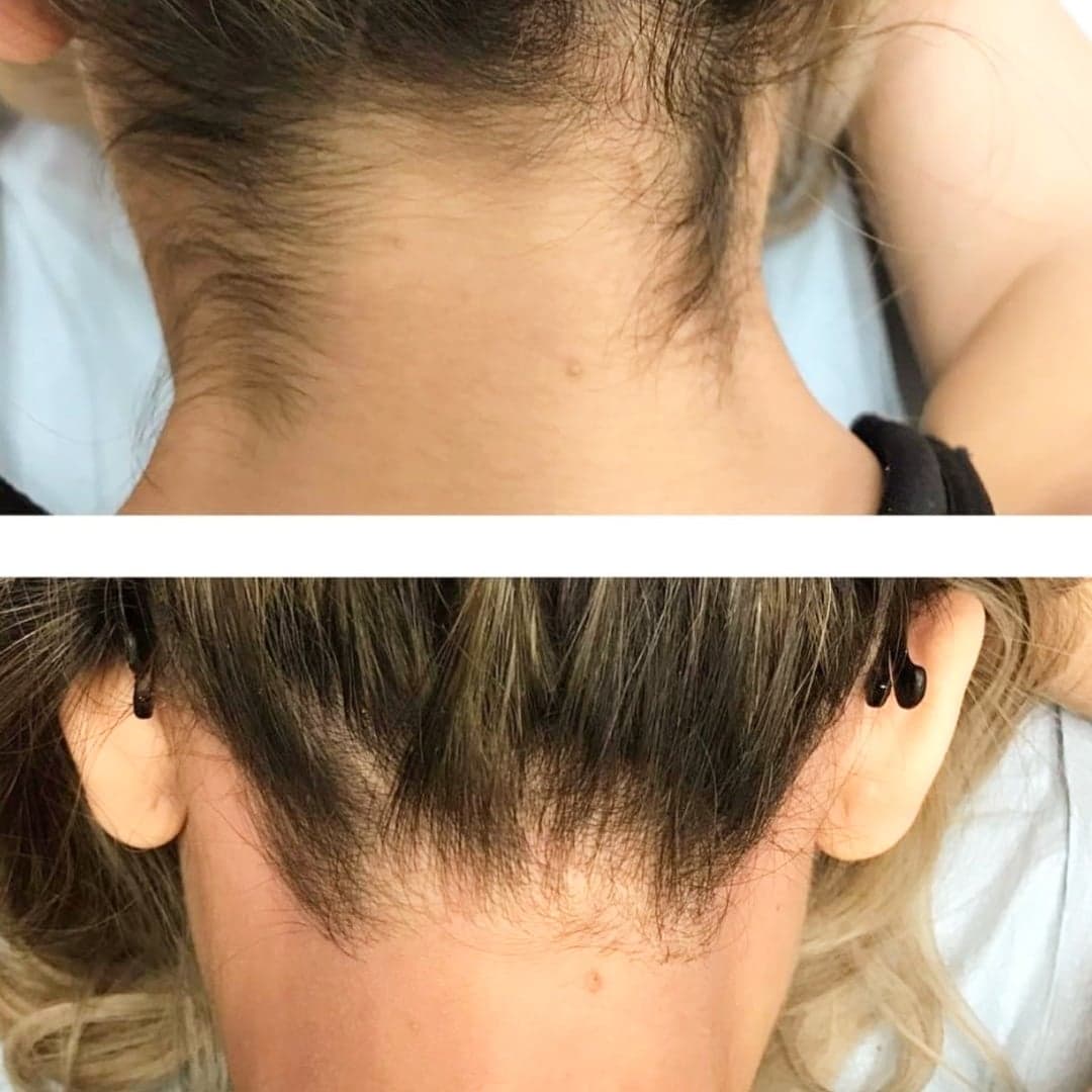 CandelaMedical1's tweet photo. Lovely result here from the Team at @skinsochic using their Gentle Max Pro to tidy up their client's neck hair...giving a cleaner appearance to her hairline.

Repost @skinsochic

Smoother, cleaner looking hair line. This was achieved after just 3 sessions

#GentleMaxPro #Gentle https://t.co/S20YdWhsnd