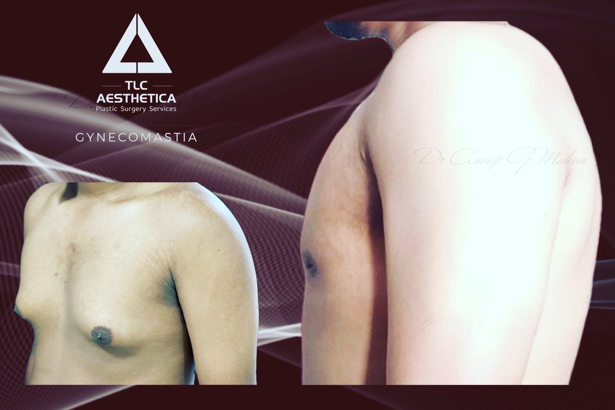 TlcAesthetica's tweet photo. #Gynecomastia 
nothing gives you results like #Trilipo 

Gland removal
Chest Contouring 
Skin tightening https://t.co/IOVcz81yBd