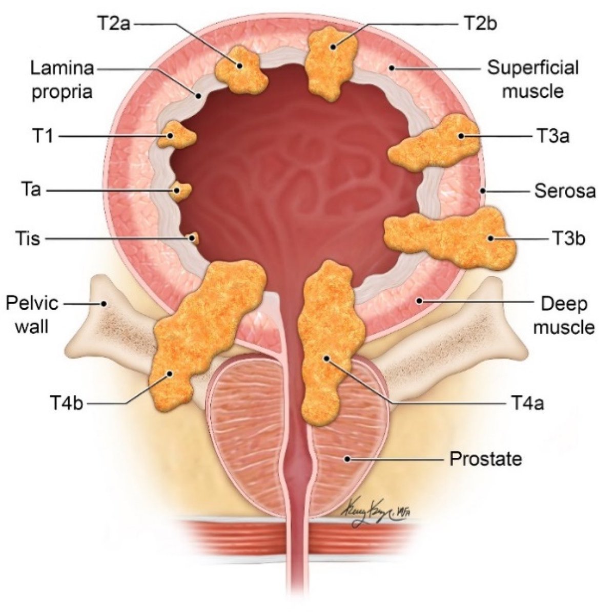 Bladder cancer staging:

Ta=limited to epithelium
T1= invasion into underlying connective tissue
T2a= inner half of muscularis
T2b= outer half of muscularis
T3a= microscopic invasion of perivesical tissues
T3b= macroscopic invasion of perivesical tissues
T4= metastatic