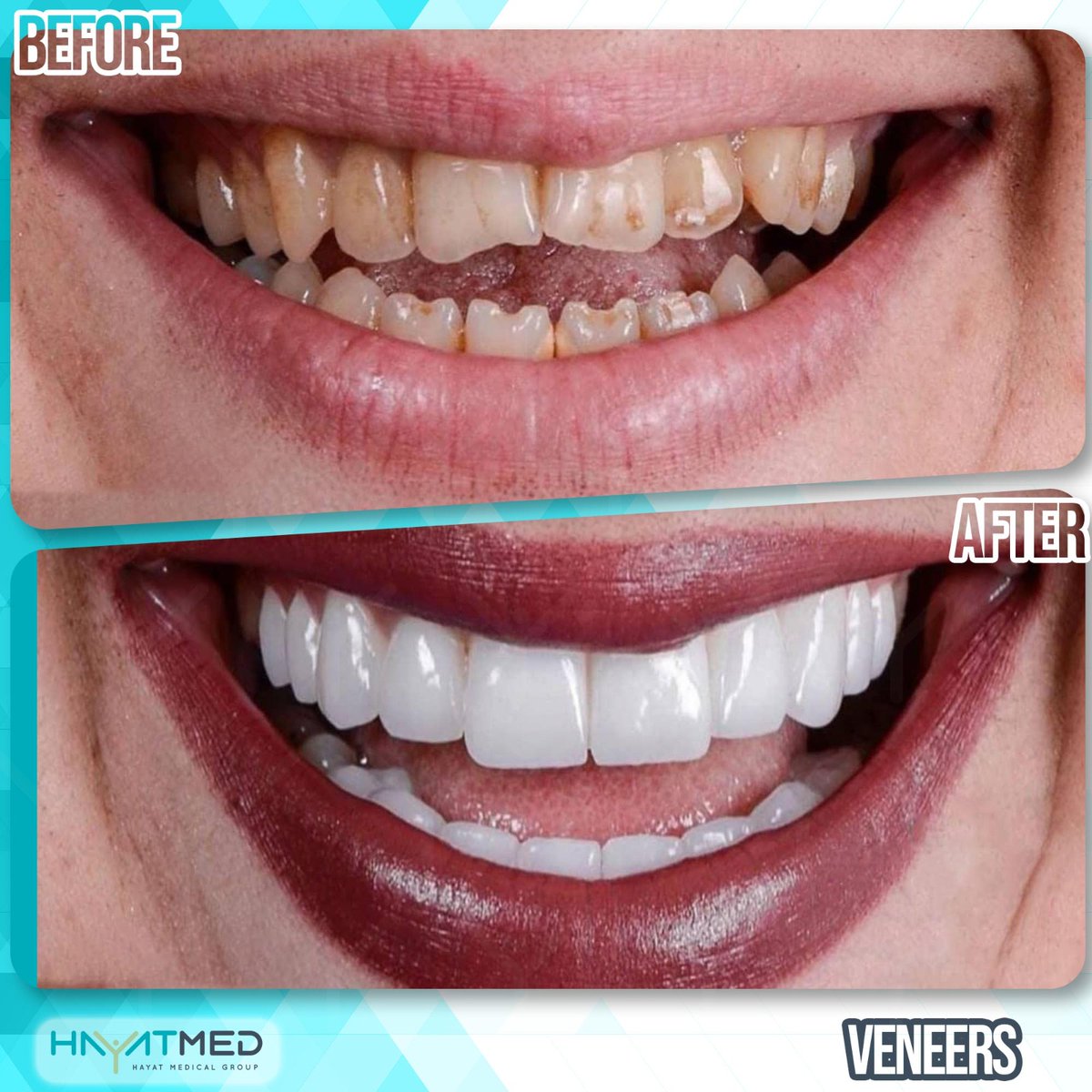 Hayatmedclinic's tweet photo. Change Your Life With #Hayatmedclinic 
#Smile #estheticdentistry #emax #laminateveneers #zirconia #beauty #lifestyle #healtylife #insta #cosmeticdentistry #aesthetic #estetik #dentalclinic #dentalcare #dental #teeth #instagood #istanbul
#smilemakeover #smiledesign #smileart https://t.co/TNK3zaDeGS