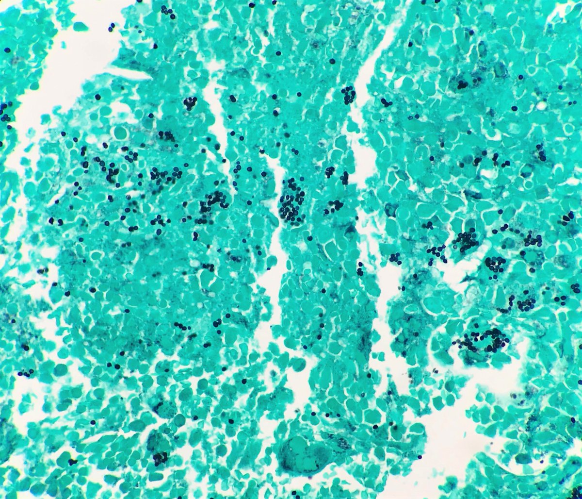 Case of Disseminated Histoplasmosis involving bone marrow in a patient who presented with prolonged fever and pancytopenia ...
# Associated with immunosuppression and high mortality rates