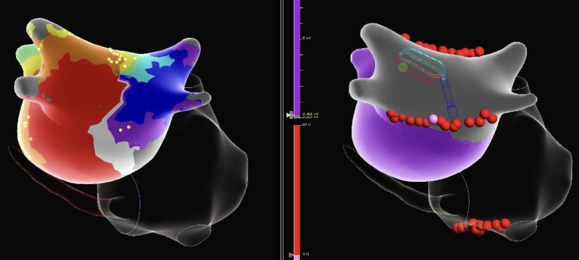 masonmaps's tweet image. #DeNovo CTI &amp;amp; AF ablation, #TypicalFlutter induced &amp;amp; CTI line completed before patient spontaneously went into #AtypicalFlutter. #HDGrid quickly revealed a pinwheel circuit on the PW, confirmed by #entrainment. PVI followed by PWI with #TactiCathSE sent pt home in NSR. #AbbottAF