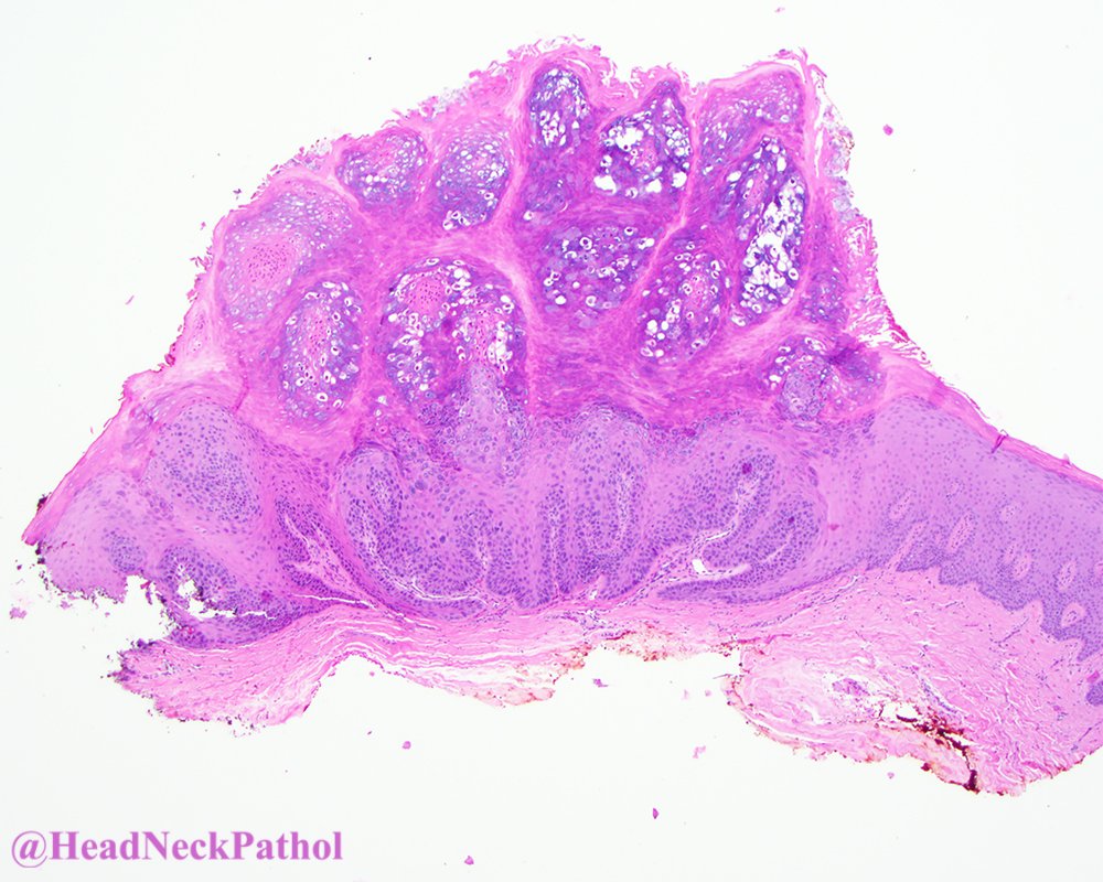 Changing Trends in Benign Human Papillomavirus (HPV) Related Epithelial Neoplasms of the Oral Cavity: 1995–2015
By Alramadhan, Fitzpatrick, Bhattacharyya, Islam &amp; Cohen
rdcu.be/cIPVh
#HeadNeckPathol #HNPJ #HeadandNeckPath #Pathology #ENTPath #PathologyTweet