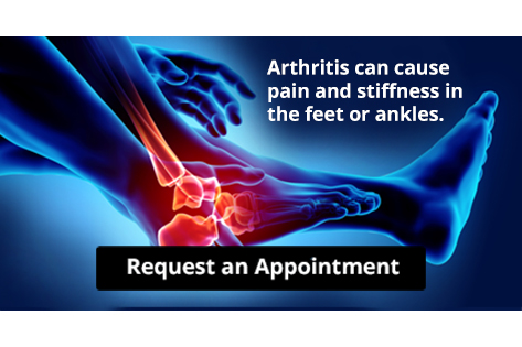 Arthritis Can Cause Pain in the Feet and Ankles dlvr.it/SLZh6Q