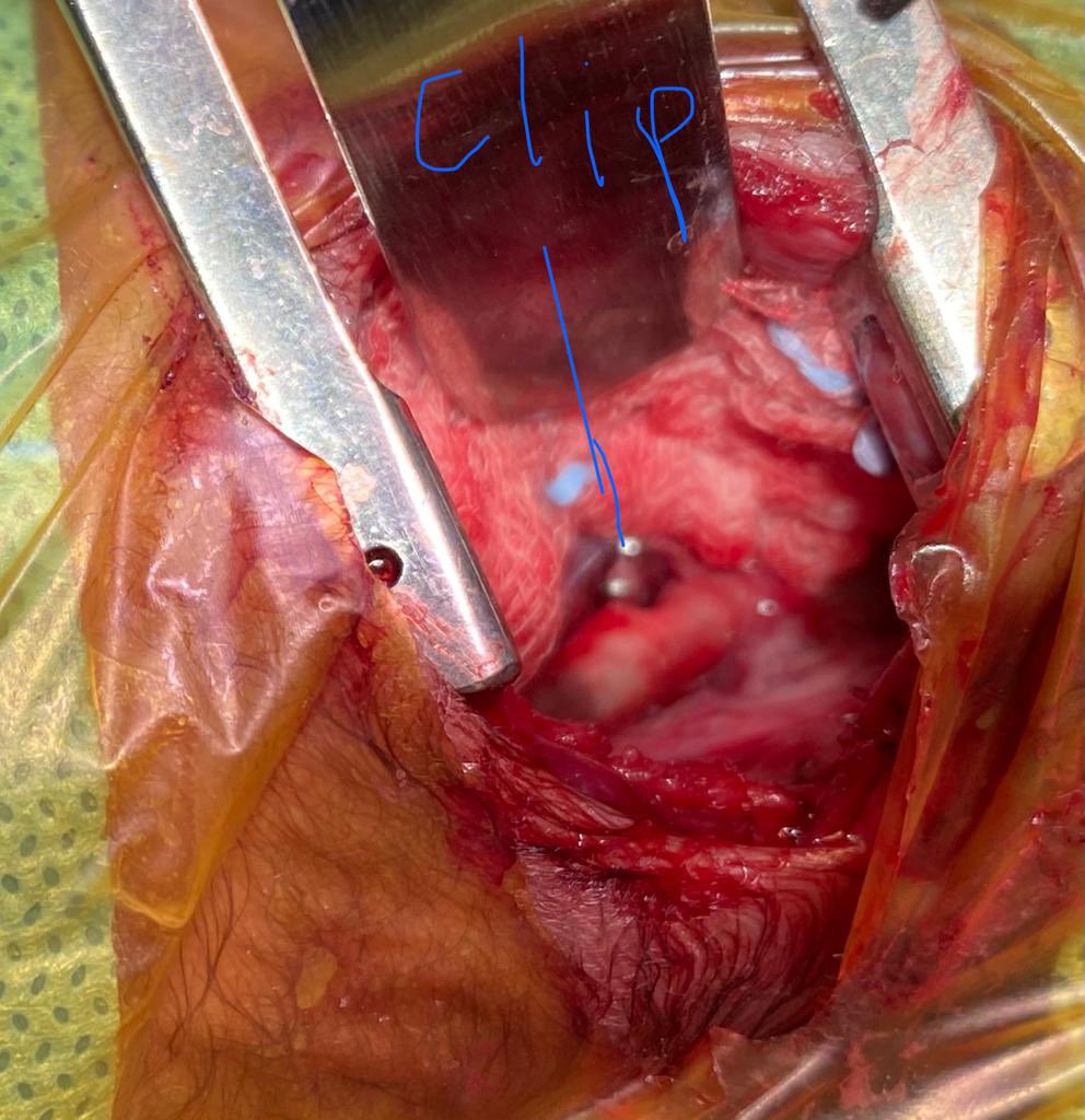 PrashanthUrs8's tweet photo. Baby born at 25 wks now is 940 gms 33 wks large PDA 4 mm non responsive to medication PDA Ligation done in NICU Apollo Seshadripuram surgery successful Baby stable Neonatology Dr Prashanth Urs Team CTVS Dr Manoj &amp; Dr Anand  cardiology Dr JayaranganatApollo Hospital Seshadripuram https://t.co/kwjzRKEOgV