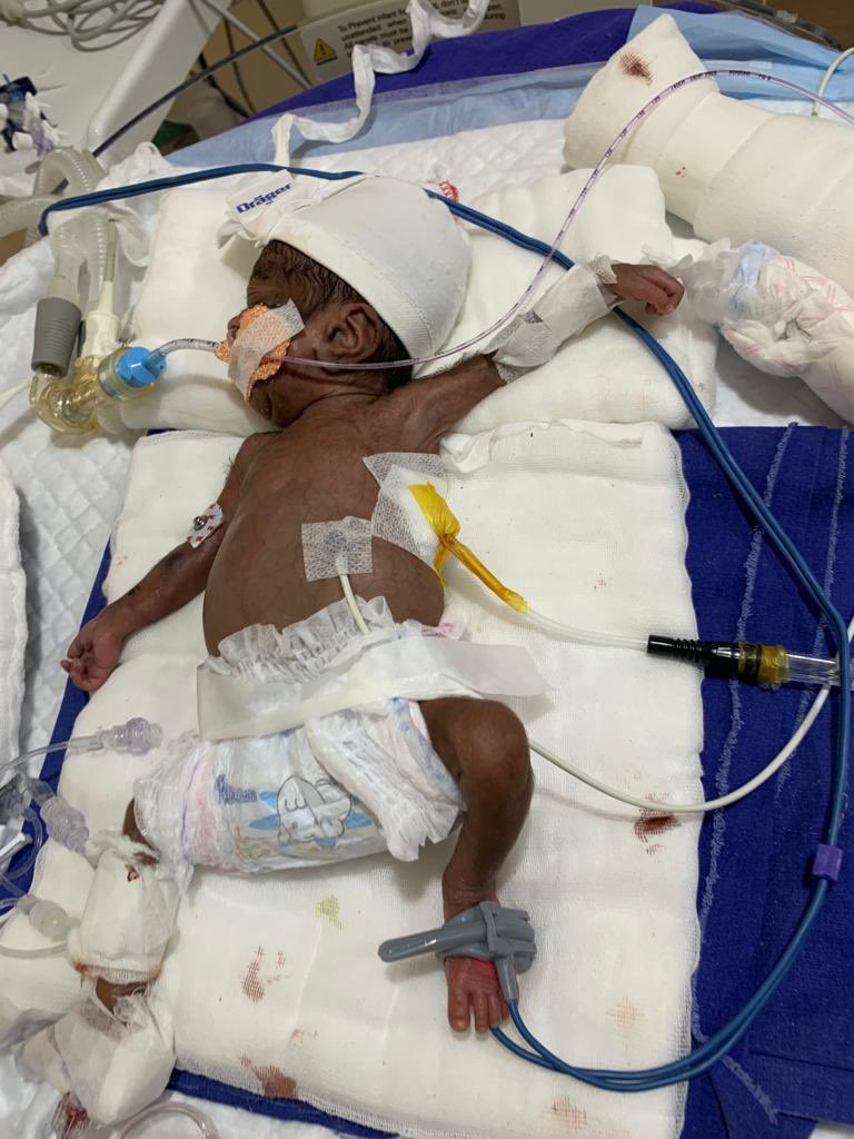 PrashanthUrs8's tweet photo. @preethareddy28 Baby born at 25 wks now is 940 gms 33 wks with large PDA 4 mm PDA Ligation cardiac surgery done in NICU A First  in Apollo Baby stableCTVSDr Manoj Dr cardiologyDR Jayaranganath Neonatology Dr PrashanthUrs teamApollo Seshadripuram https://t.co/zFmDFz0Epb