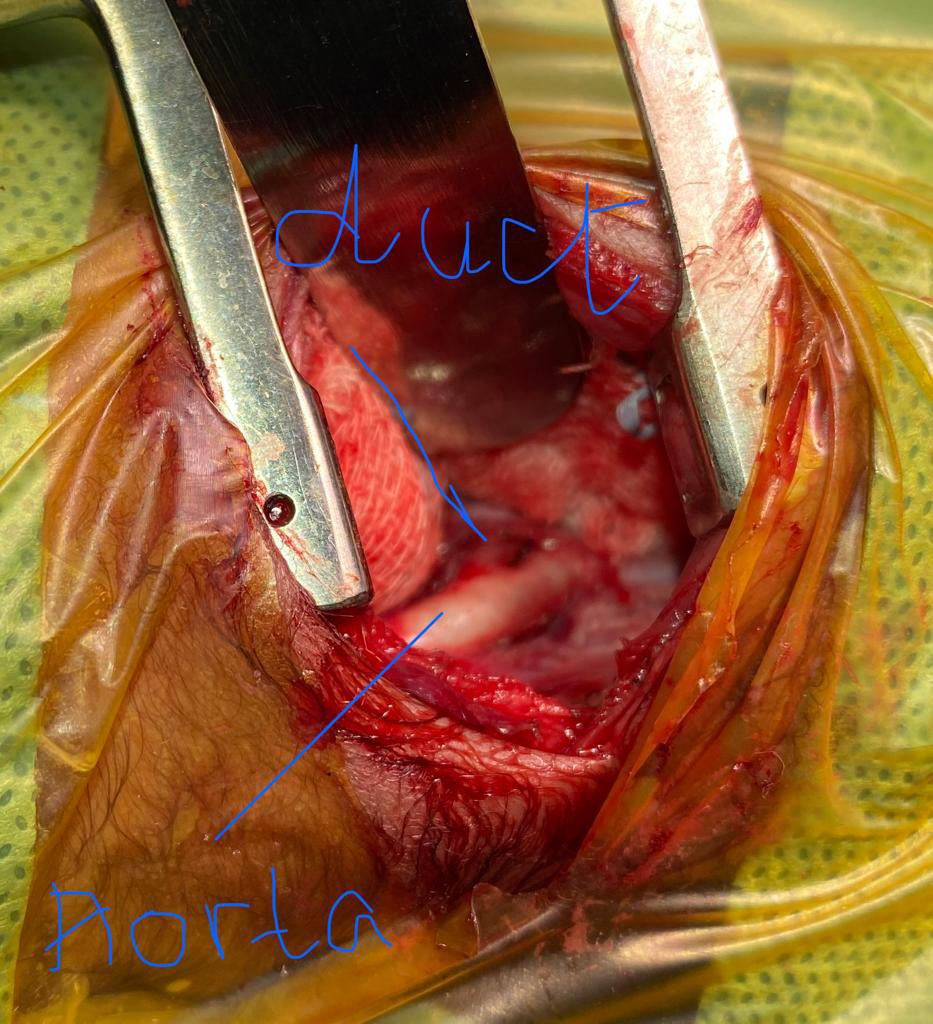 PrashanthUrs8's tweet photo. @preethareddy28 Baby born at 25 wks now is 940 gms 33 wks with large PDA 4 mm PDA Ligation cardiac surgery done in NICU A First  in Apollo Baby stableCTVSDr Manoj Dr cardiologyDR Jayaranganath Neonatology Dr PrashanthUrs teamApollo Seshadripuram https://t.co/zFmDFz0Epb