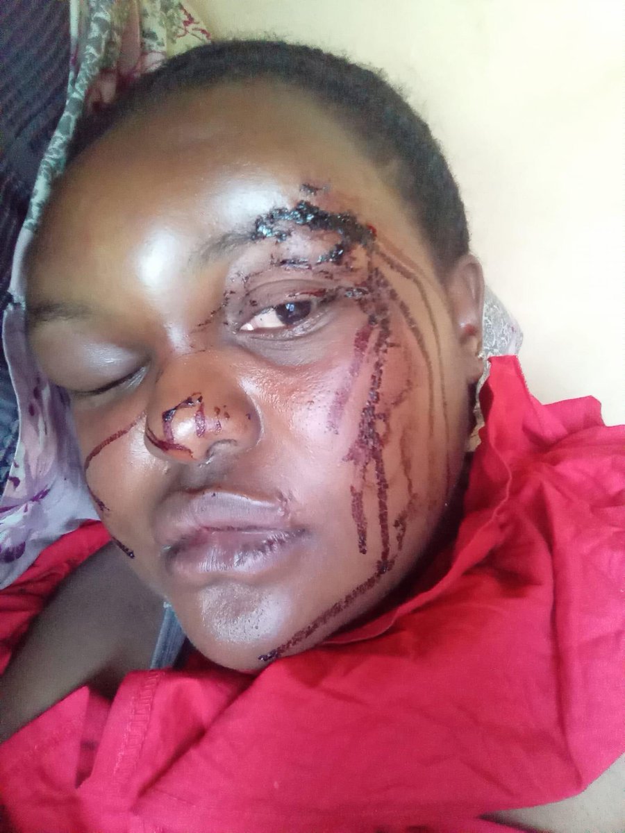 AdvoBarryRoux's tweet photo. This lady is Pearlz Skhenjana from Stanger. She was beaten by her baby daddy, he smashed her face with a concrete brick. https://t.co/Dn3Q7Tdhpk
