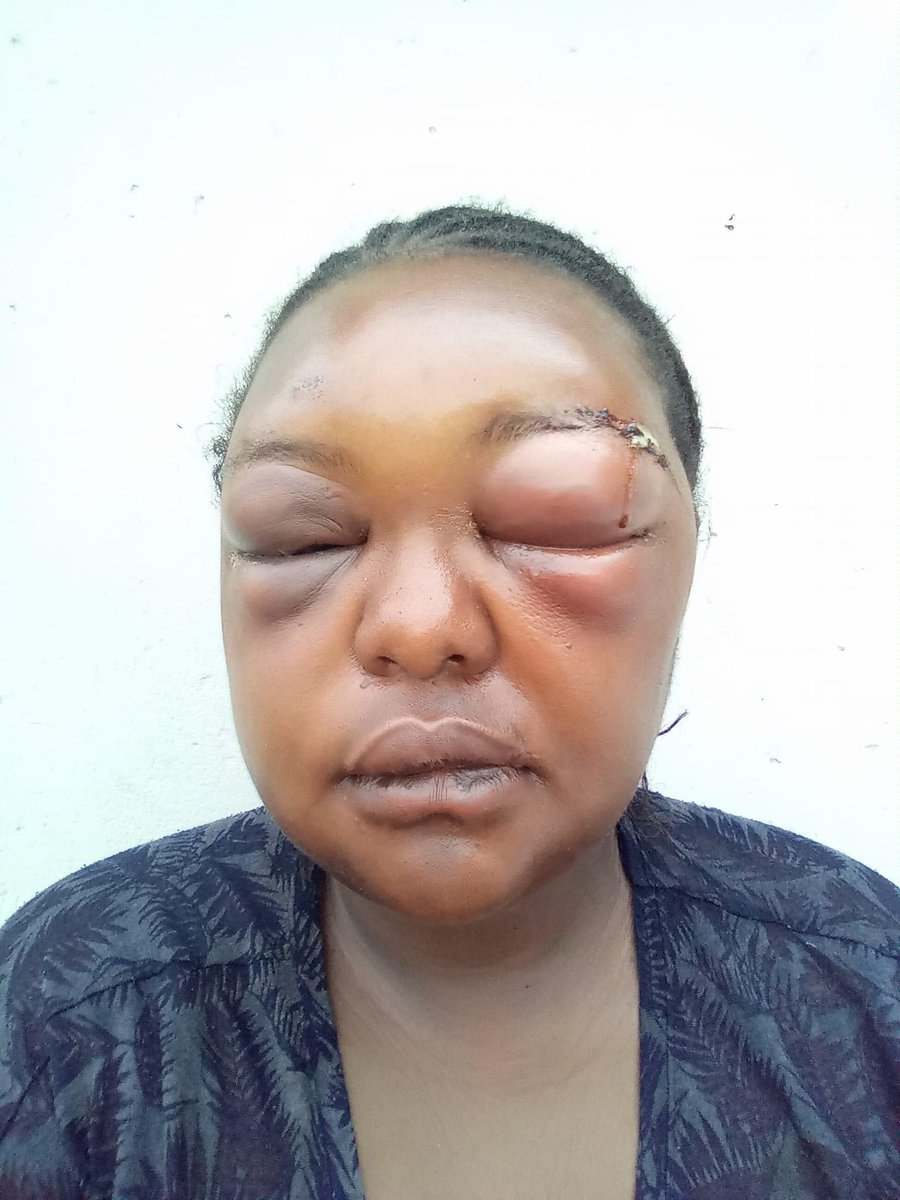 AdvoBarryRoux's tweet photo. This lady is Pearlz Skhenjana from Stanger. She was beaten by her baby daddy, he smashed her face with a concrete brick. https://t.co/Dn3Q7Tdhpk