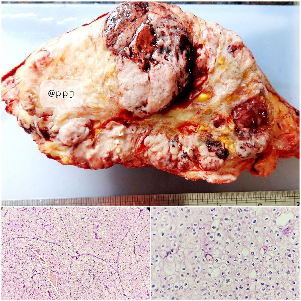 padmapathology1's tweet photo. Metastatic/ recurrent chromophobe cell carcinoma #MacroMicroCorrelation https://t.co/PylSiIqGjE