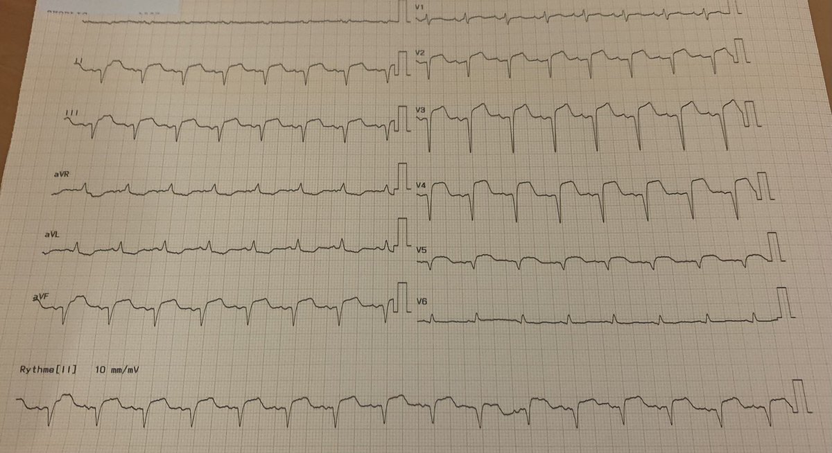 linternedegarde's tweet photo. 3h00 garde dans un hôpital pas si lointain.
L’infirmière d’accueil arrive rapidement avec un patient et cet ECG: « c’est typique, je me trompe pas », elle a:
1-reconnu une douleur typique
2-fait l’ECG
3-reconnu un problème
4-fait gagné du temps
Formons les paramed à l’ECG
Merci https://t.co/i83OT07qmG