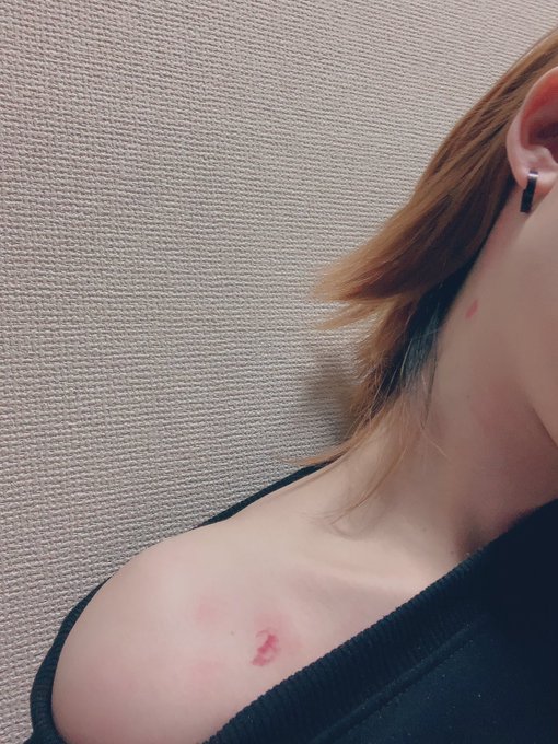 ゆのさんに首と肩にしっかりキスマークつけてもらいました 