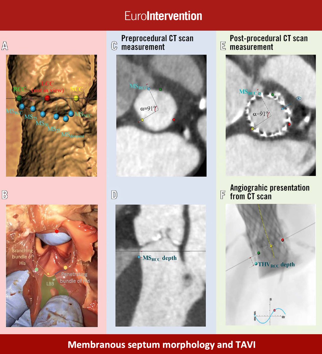 EuroIntervention tweet media