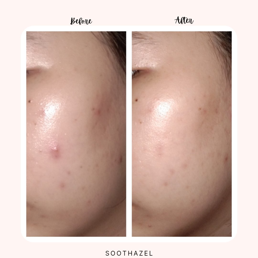 blushyrosy_'s tweet photo. Calling everyone yg mau punya kulit sehat & skin barrier yg kuatt๐จ
Aku mau rekomendasiin hydrating serum yg baguss bgt, cocok for all skin type!
Halalโ
Non Alcoholโ
Non Parabenโ
No Coloringโ
Adara Overnight Skinpair Concentrate๐โจ
@Adara_ID
#racuninskincare #StepUpnGlow https://t.co/GEeBlKz00o