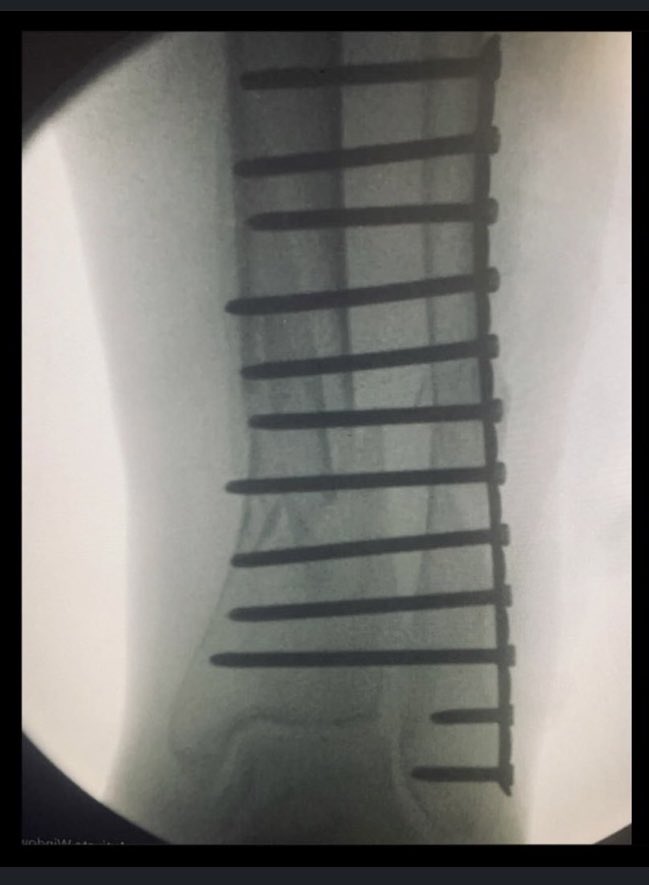 Naan Derthaal, DO, FAAOS tweet media