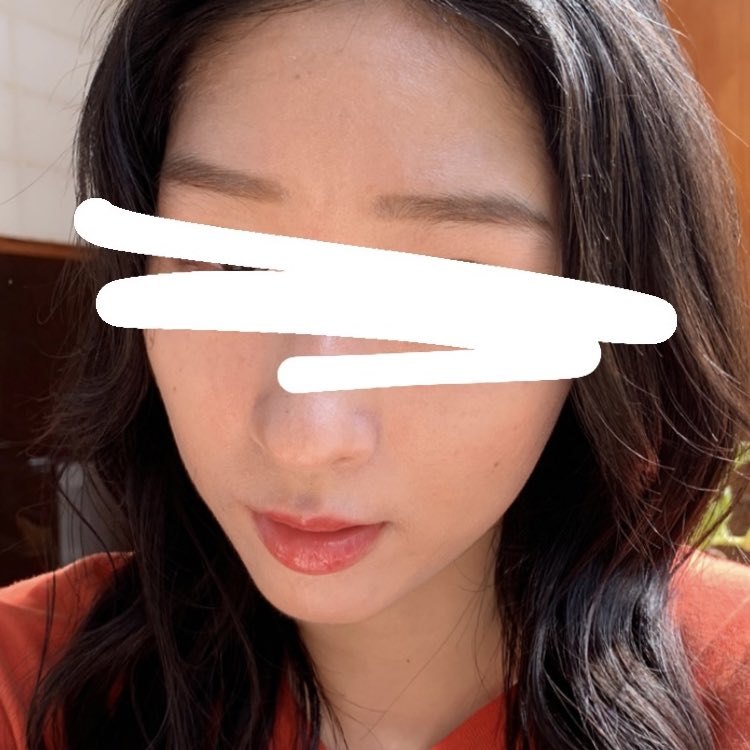 nik59873681's tweet photo. アキュテイン辞めて10ヶ月(くらい？)
化粧してるとわからないけど、プチっと小さいニキビは口周りに結構できる😵‍💫小さくすんでるのと割とすぐ治るのはアキュのおかげかなあ〜
化粧ありノーマル外カメ https://t.co/WrOVJjZeki