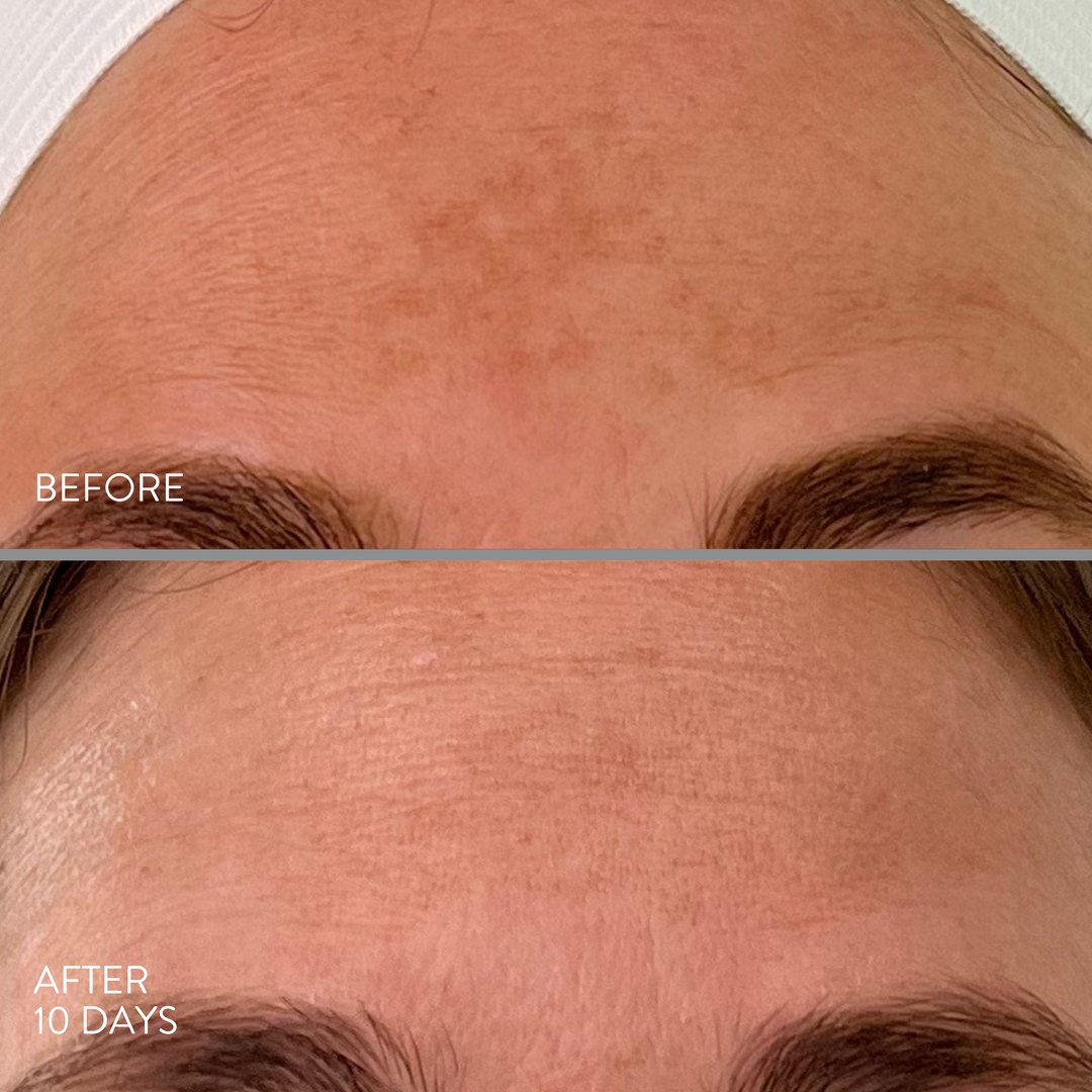 The M-Peel, performed at Lancer Dermatology in Beverly Hills, is a proprietary chemical peel that effectively targets melasma and discoloration. There is nothing better than seeing our patients looking their best. #LancerGlow ✨