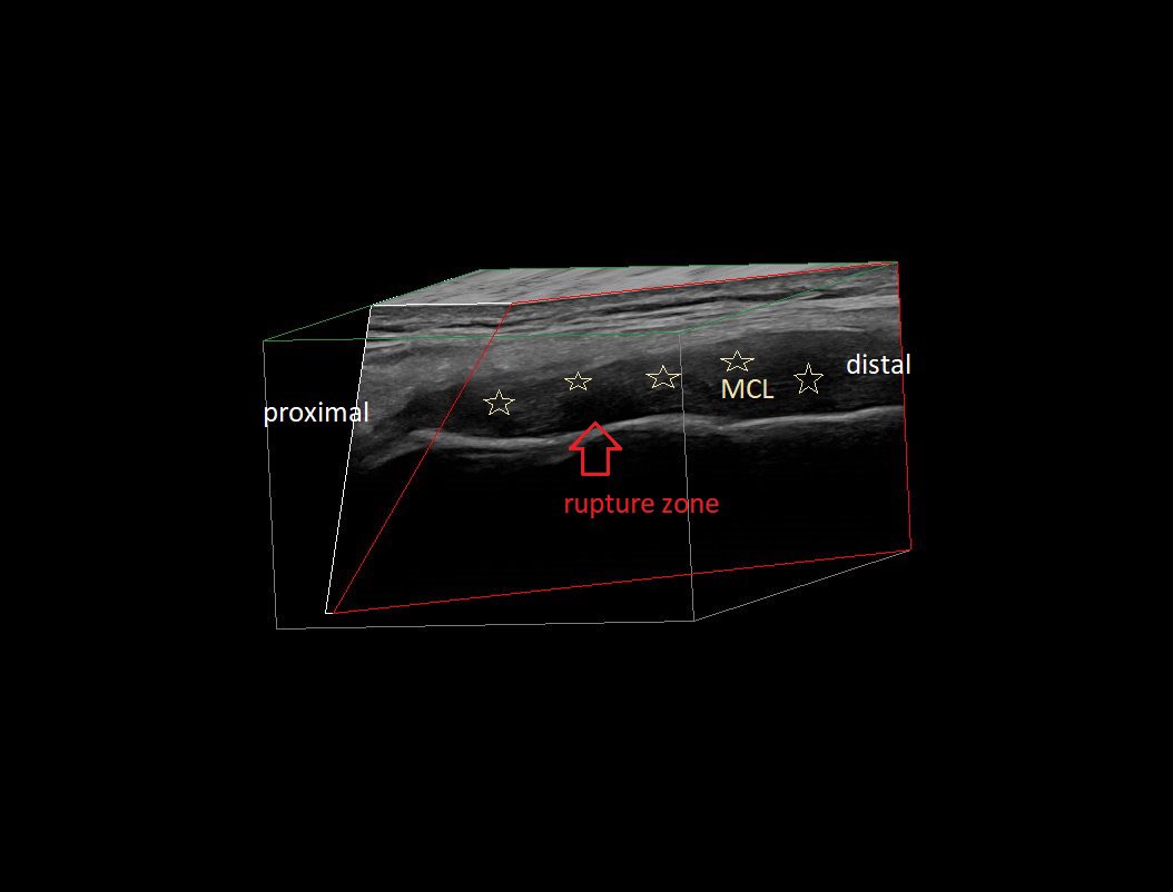 SportklinikBern's tweet photo. #ultrasoundguidedinjection #arthrexacp of a partial tear of the #mcl of the knee - #mskus #pocus #pocushub #logiqE10 #kneeinjury https://t.co/aUSuMSfalS
