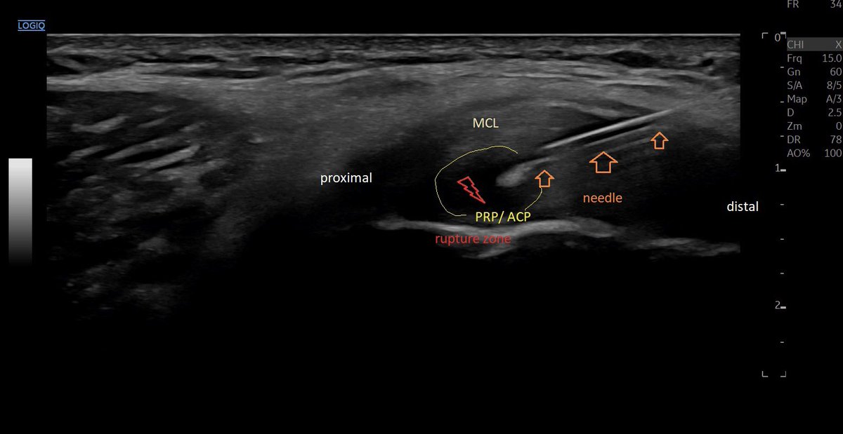 SportklinikBern's tweet photo. #ultrasoundguidedinjection #arthrexacp of a partial tear of the #mcl of the knee - #mskus #pocus #pocushub #logiqE10 #kneeinjury https://t.co/aUSuMSfalS