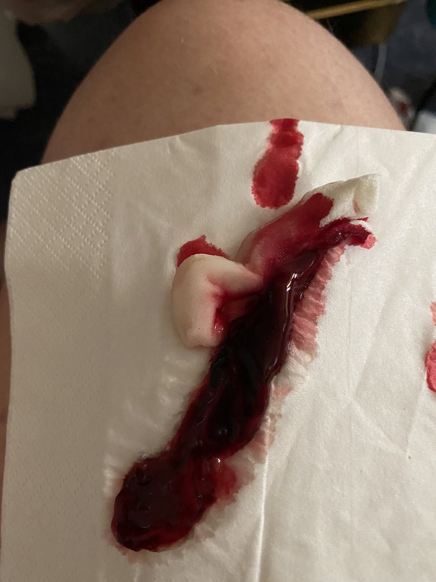 Ollut huonona useamman päivän eikä näytä verenvuoto enää lakkaavan kuin tollo nenässä ja hyytymään saadaan vaan. Nielen joka päivä verta, kuumetta ja huonovointisuus aikamoista välillä. Tää on aamusta. Tän kun veti nenästä ei tarvi ihmetellä, et tuntuu et tukehtuu. 10cm pötkö.