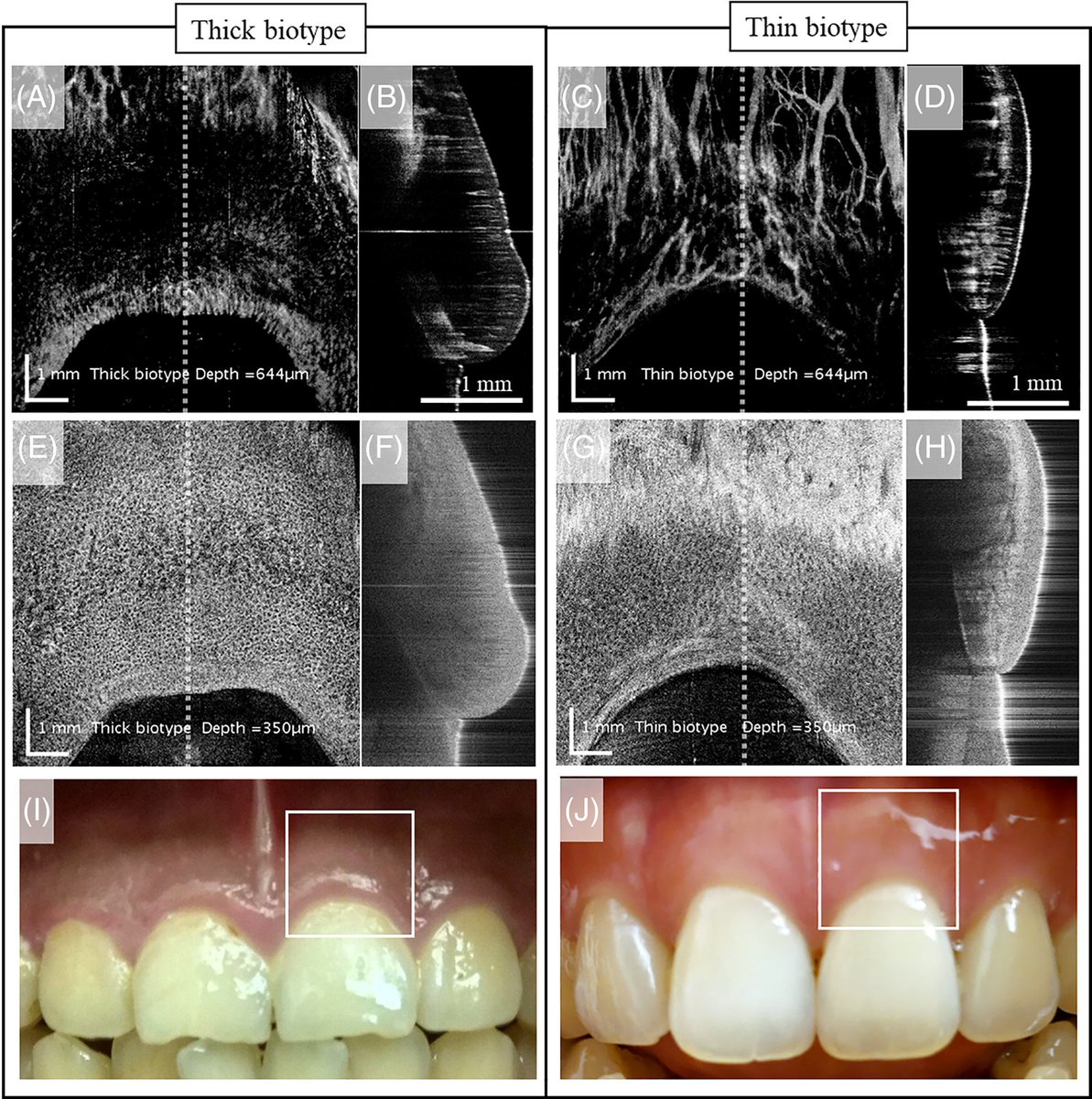 Methods of assessing gingival biotype

#Dental_by_Hadeel https://t.co/KLbLaJFZhd