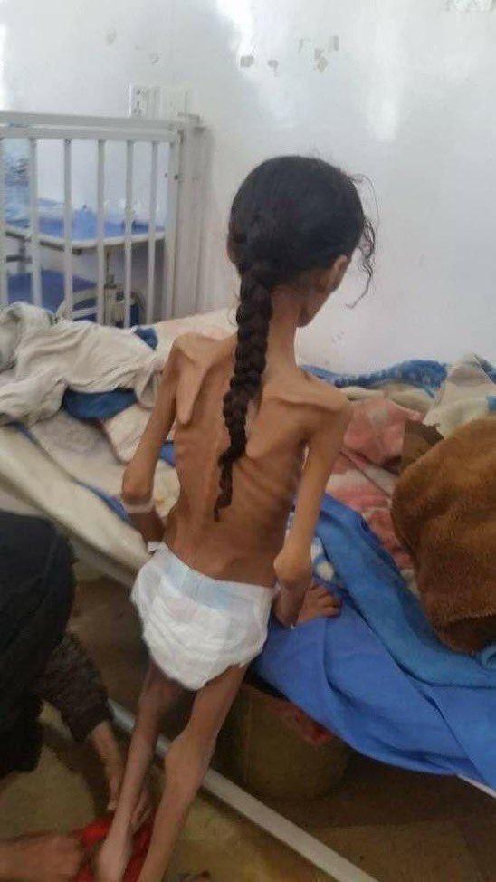 JournalismPopal's tweet photo. This is a child from Yemen. These are the effects of the inhumane famine and bombing of Yemen by Saudi Arabia.

Afghans stand in solidarity with the people of Yemen. https://t.co/cN8iQE82Ou