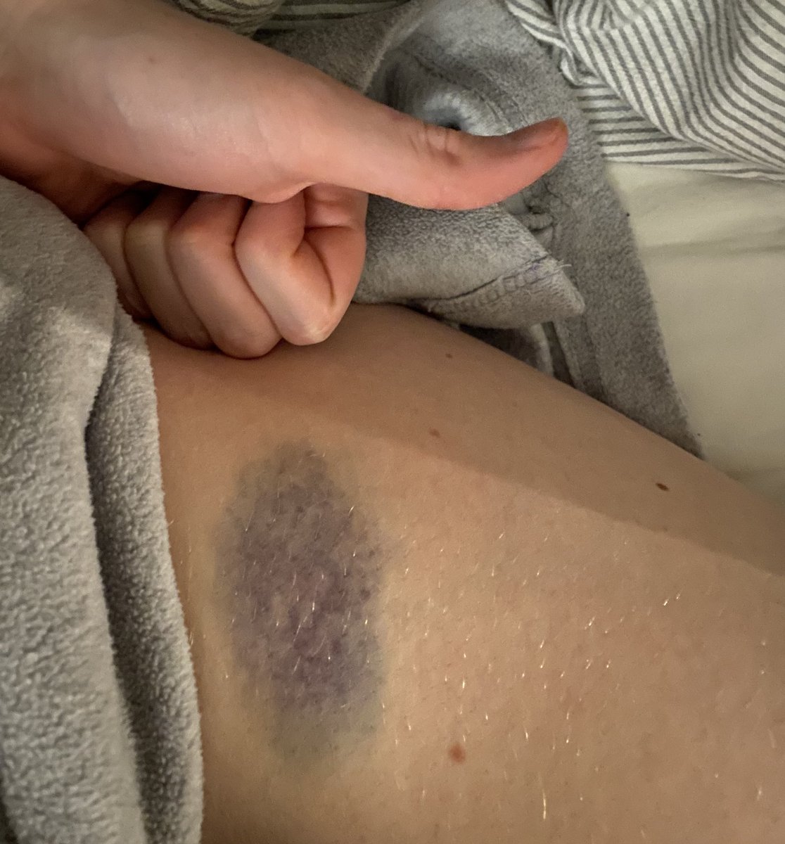 elinrosag's tweet photo. Lagið I bruise easily er í rauninni samið um mig😊 hef líklegast labbað á borð (eða verið stungin með forlátum atgeir) á föstudaginn og vaknaði með þetta ferlíki á lærinu https://t.co/bW9T0Lb37x