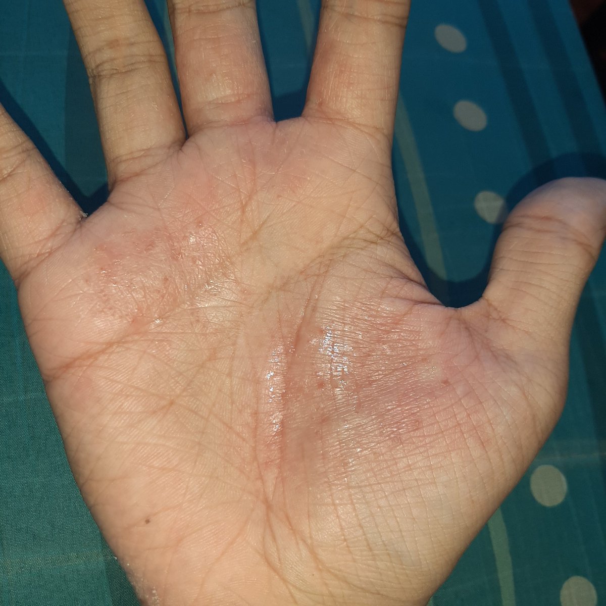 Can anyone help me with my hand? 
Its been there for nearly 2 yrs now and its getting annoying and its embarassing... 
Can anyone tell me what this is and how to get rid of it? thankss 😭