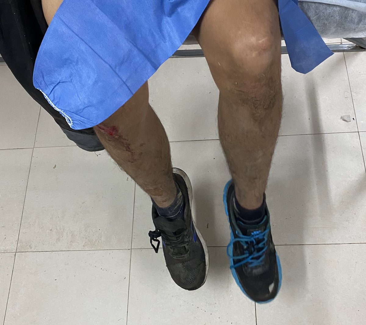 Contexto recital La Renga: 
un chabon vino a hacerse atender con DOS ZAPATILLAS DIFERENTES Y LAS DOS DERECHAS JAJJA lo peor es que se dió cuenta en ese momento y no tenía idea cómo pasó