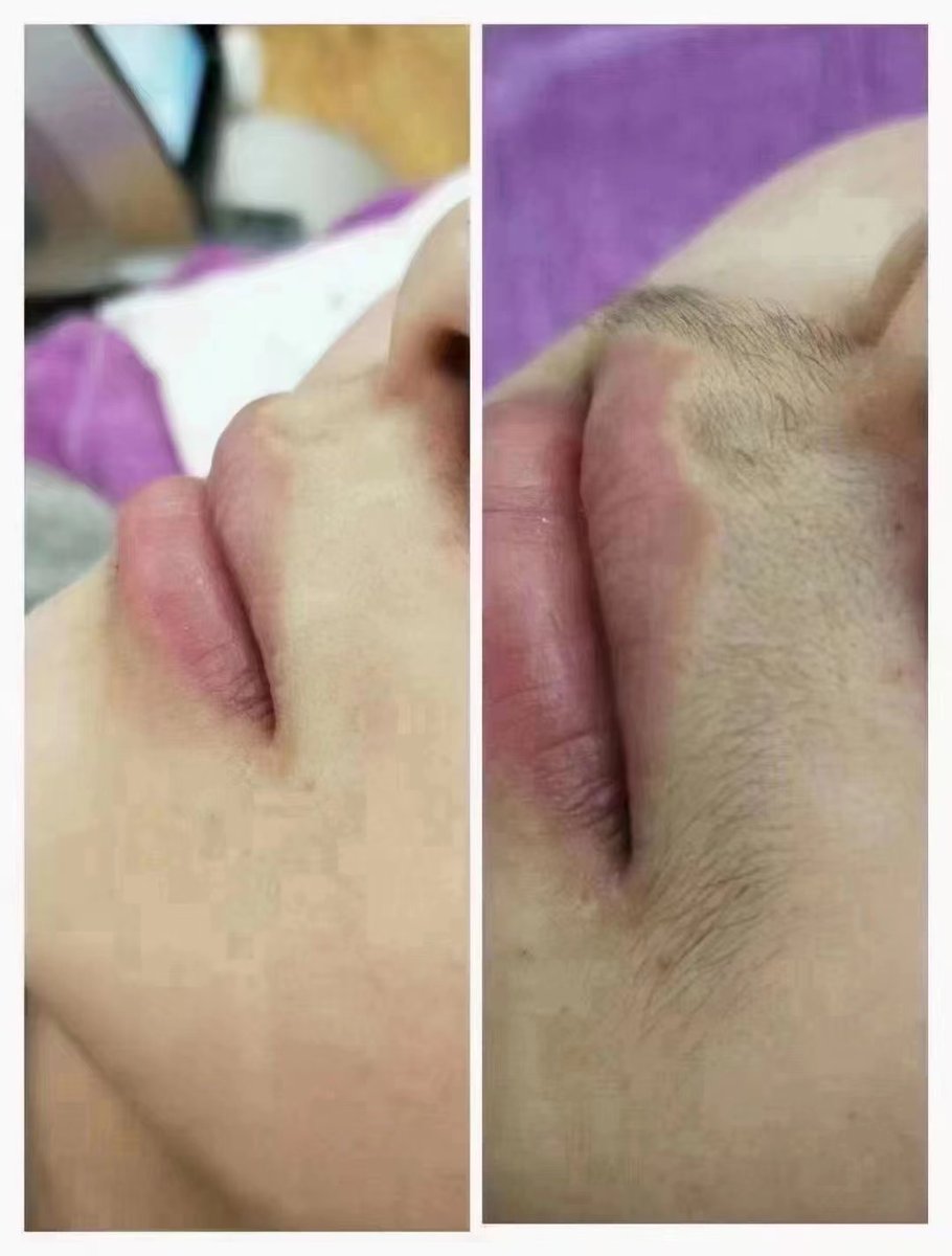 EVALASERTECH's tweet image. #vcsellaser #sldlaser #lazerepilasyon #lazerepilyasiya #diodelaser #laserhairremoval #cryoemsculpt #emsculpt #emsculptneo #laserhairremoval #gentlemaxpro #emsculptneo #emsculpt #diodelaser #picosecondlaser #co2laser #fractionallaser #fractionalco2laser #cryotherapy #cryolipolisis