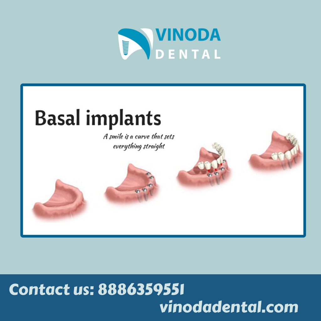 VinodaDental's tweet image. A Smile is a curve that sets everything straight. Basal implants are those types of implants that are placed in the basal bone.

Contact now: 088863 59551, 099854 32424.

Book Appointment: vinodadental.com/appointment

#smile #basal #basalimplants #vinodadental #dentalhospital