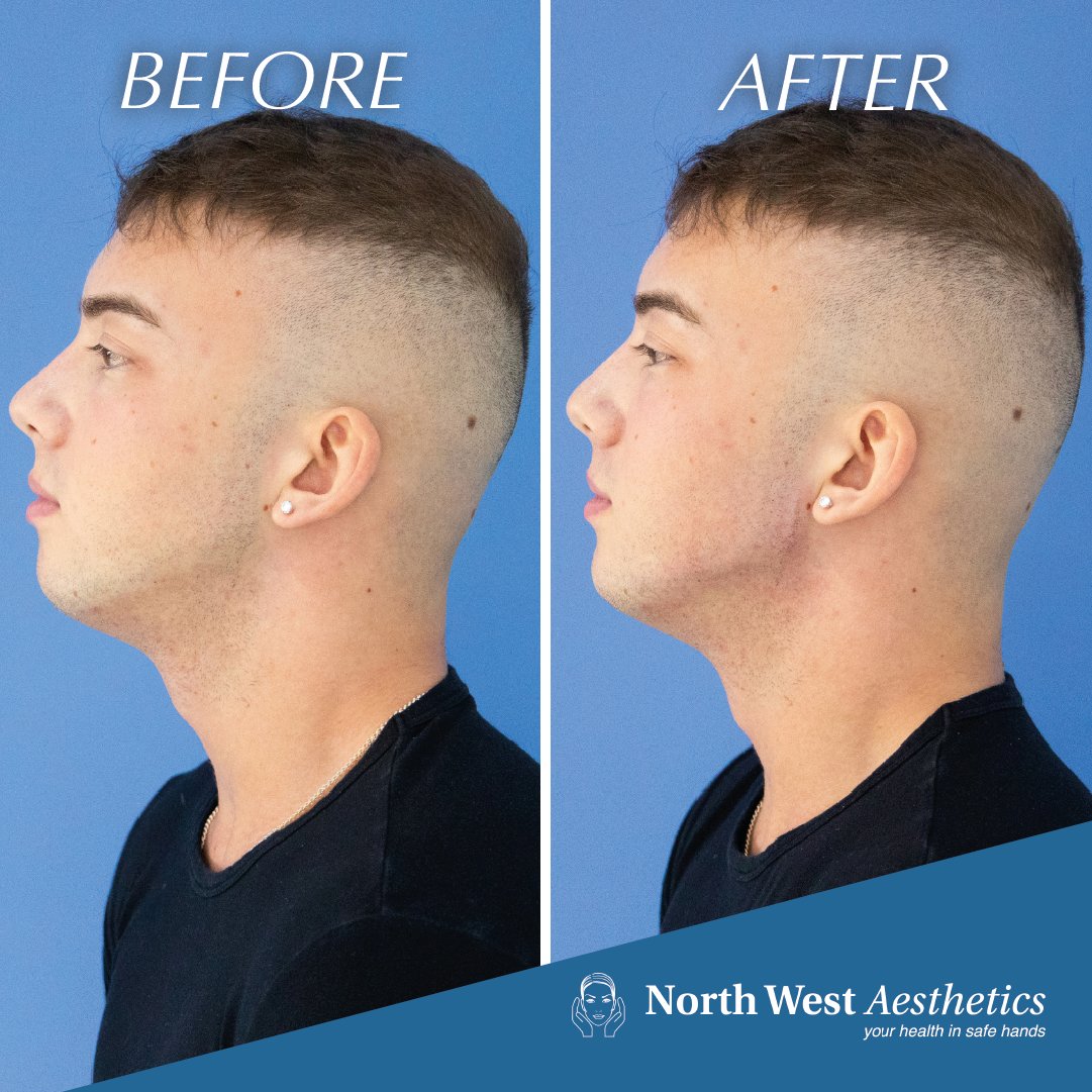 Restructure your lower face with #DermalFillers. Reimagine the angle and prominence of the #chin and #jawline in one simple treatment. Book your consultation at #NorthWestAesthetics.