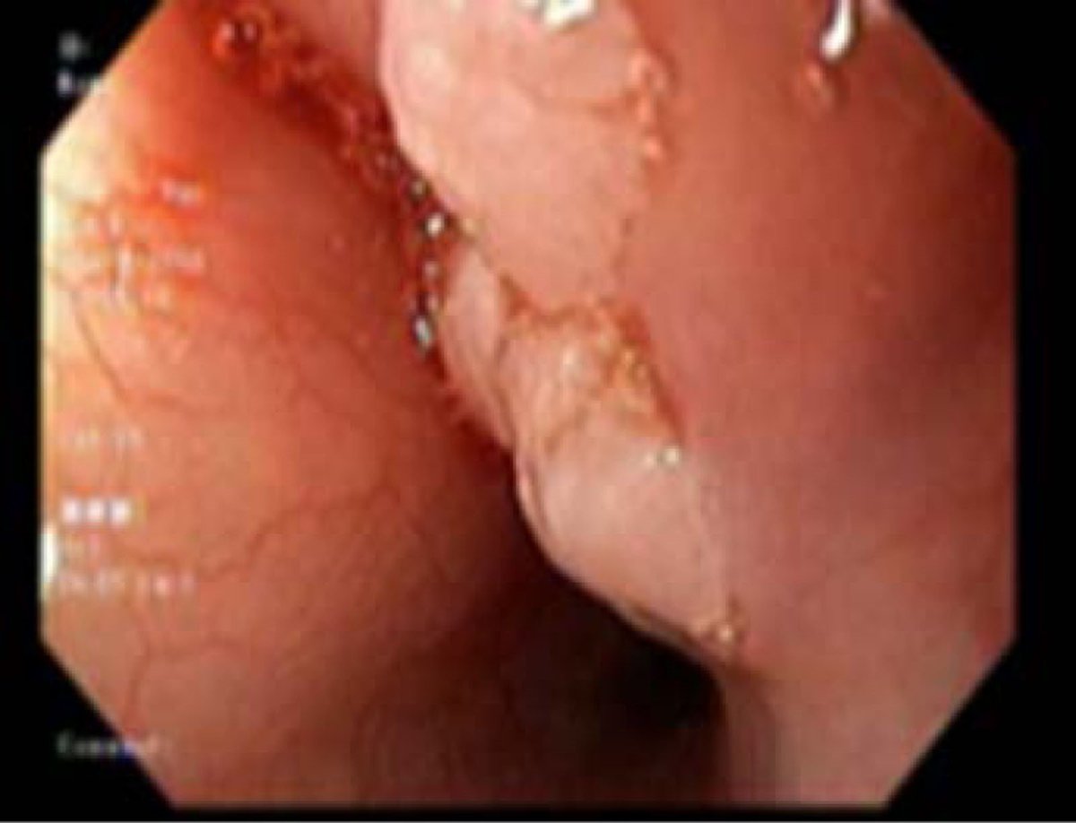 JPGNReports's tweet photo. 4 patients with #esophageal squamous #papillomas: possible treatments include #antacids and #HPV #vaccine. Read more:
https://t.co/k9F75HJFy5
#openaccess #pedigitwitter #pedsgi https://t.co/fexr1yPr9E