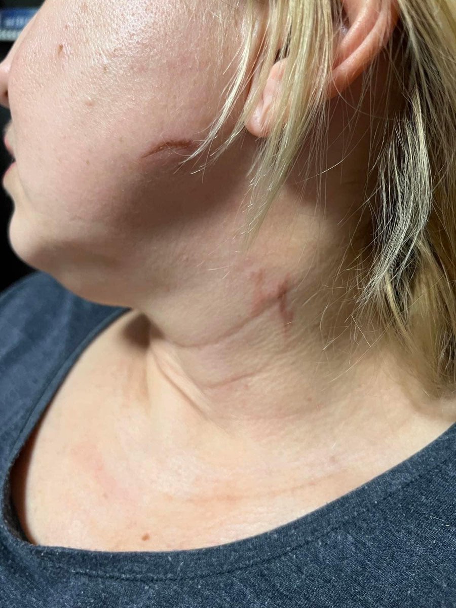 avalaina's tweet photo. Dmitriy Shylin: My wife was stopped by a Russian patrol. They asked her passport. Then they put the machine gun to her face and said: tell us that Kherson is Russia. My wife replied: Kherson is Ukraine. We have the following consequences (photo). I am proud of her and I love her https://t.co/DSkyWsM1ux