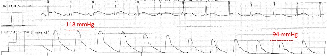 Atrial kick matters more in some than others.
Note the drop in systolic BP when accelerated junctional rhythm overtakes sinus rhythm.  V-V synchrony and rate are the same.  Only a loss of A-V synchrony explains the abrupt 24 point drop in SBP.