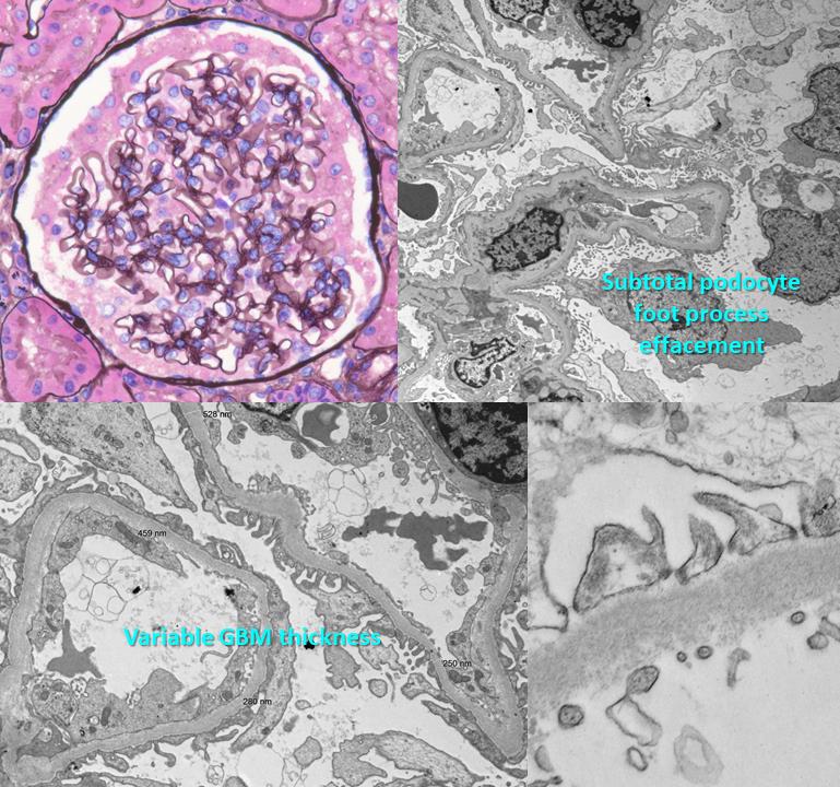 JeanHouMD's tweet photo. Progressive FSGS: Child w/ FSGS bx'ed in 2019, steroid non-responsive, switched to Tacrolimus, now w/ 40% global glomerulosclerosis and juxtaglomerular apparatus hyperplasia (reported w/ CNI toxicity).  GBM variably thickened, podocytes partially effaced. Genetic testing pending. https://t.co/uBdDAT3HqE