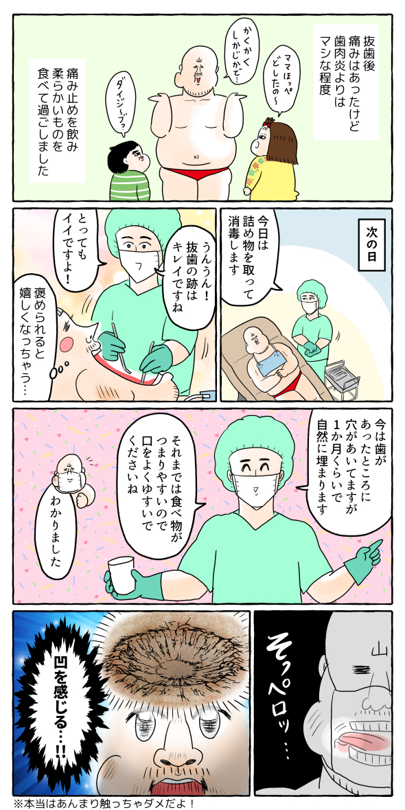 【歯】下の親知らず抜いた話④(完) 