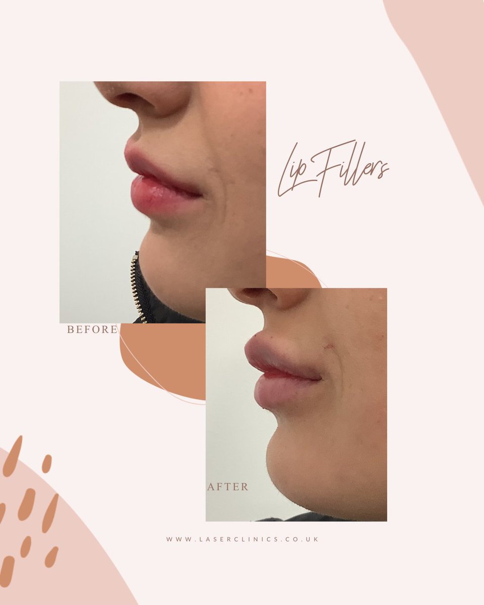 bewildered_by's tweet photo. Get the Lips you deserve 💋

The results speak for themselves - we adore giving you the results that you desire!

@laserclinicsuk_liverpool https://t.co/yBRiMDPJ9T