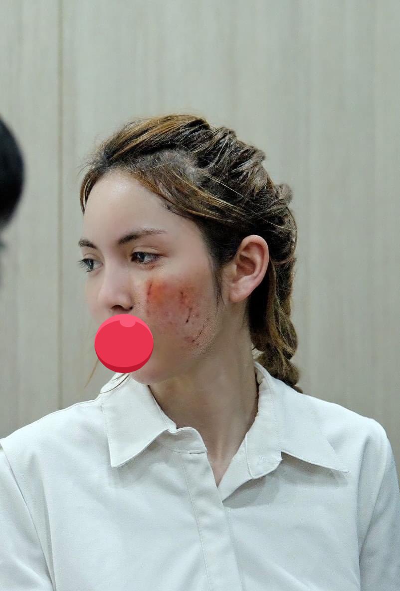 iceij_'s tweet photo. แล้วดูแผลของคุณโนอาดิ จะเอาอะไรมาอ้างมันก็ไม่ขึ้นแล้วอะทำร้ายร่างกายจนหน้าเค้าเป็นขนาดนี้ ยังมีความเป็นคนอยู่หรือป่าวหลักฐานที่แน่ชัดที่สุดก็รอยบนหน้าเค้านี่แหละ ทำร้ายร่างกายก็คือทำร้ายร่��งกายค่ะ จะเ้วยเหตุผลอะไรก็ไม่ควรทำถึงขนาดนี้ #โนอา https://t.co/SDetI7Fuzn