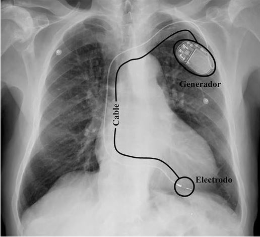 Dispositivos #Cardiacos electrónicos implantables: lo que un #Radiólogo general debe saber 

🔎Los autores del #PiperSERAM de la semana evalúan los distintos tipos de dispositivos y detallan sus posibles complicaciones 

¡No te lo pierdas! ➡️bit.ly/3tHvlwm