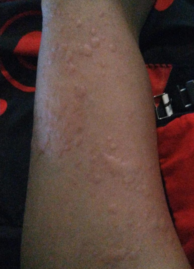 onotrakVD's tweet photo. Tolong donk @KemenkesRI saya mengalami gatal2 alergi setelah vaksin AZ dan kata dokter kulit sudah kronis. Saya lihat juga banyak yg mengalaminya selain saya, apakah tdk ada response? 
#efeksampingvaksin #alergivaksin #alergivaksinasi #alergi #gejalavaksin #gatalsetelahvaksin https://t.co/4yoLDKsPTo