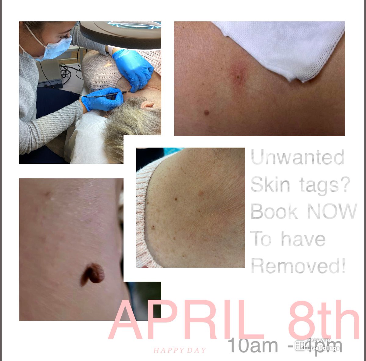 revivifymedispa's tweet photo. Don't miss out this April 8th Skin Tag Removal clinic with Nurse Amanda. I know we are sick and tired of skin tags making us feel not our best!

#skintagremoval #skintagremoval  #skintagtreatment #facialtreatment #skintreatment #Kitchener #waterloo #cambridgeontario #stratford https://t.co/vydPxYqi0m
