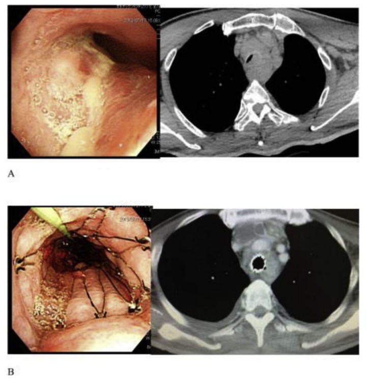 British Journal of Anaesthesia (@bjajournals) on Twitter photo What can airway stenting achieve?
(A) Severe extrinsic tracheal compression
(B) uncovered metallic stent.
Read our #BJAEducation article by <a href="/BarnwellNiamh/">Niamh Barnwell</a> and Dr Lenihan on how anaesthesia can facilitate such achievements
#Airway <a href="/AirwayInfo/">airway.management</a>
bjaed.org/article/S2058-… What can airway stenting achieve?
(A) Severe extrinsic tracheal compression
(B) uncovered metallic stent.
Read our #BJAEducation article by <a href="/BarnwellNiamh/">Niamh Barnwell</a> and Dr Lenihan on how anaesthesia can facilitate such achievements
#Airway <a href="/AirwayInfo/">airway.management</a>
bjaed.org/article/S2058-…